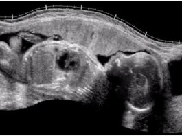 Fetal Heartbeat