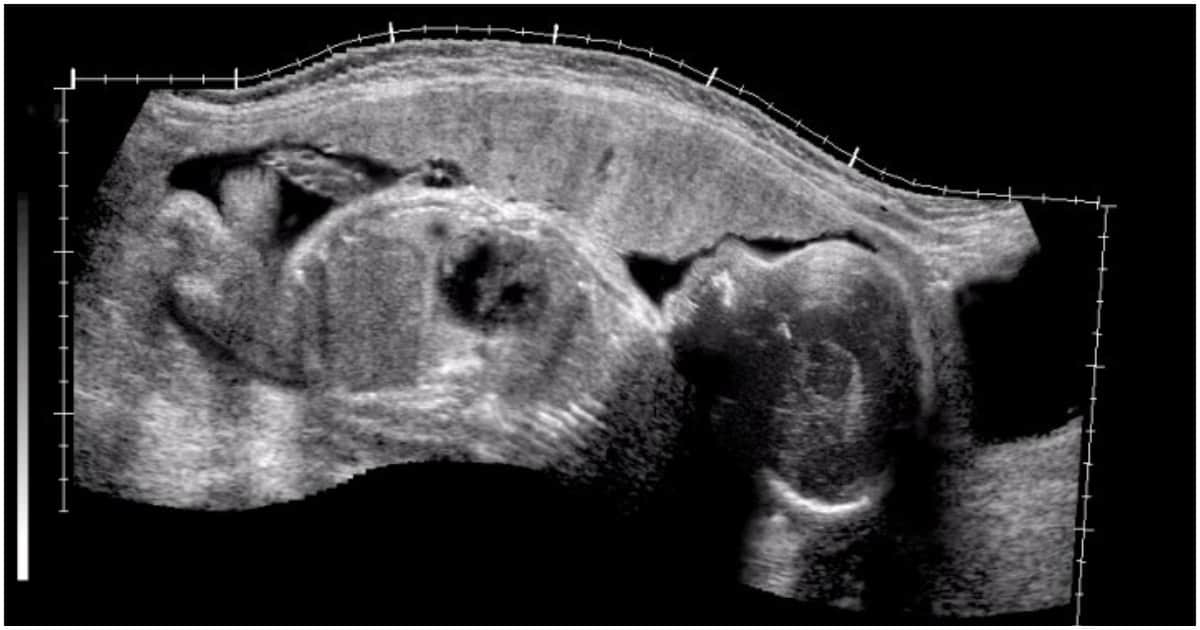 Fetal Heartbeat